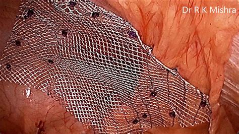 inguinal hernia repair with mesh cpt code